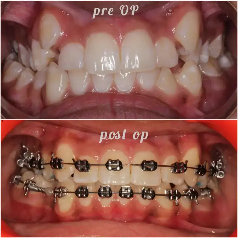 Braces Treatment