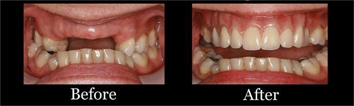 Crown and Bridge Treatment