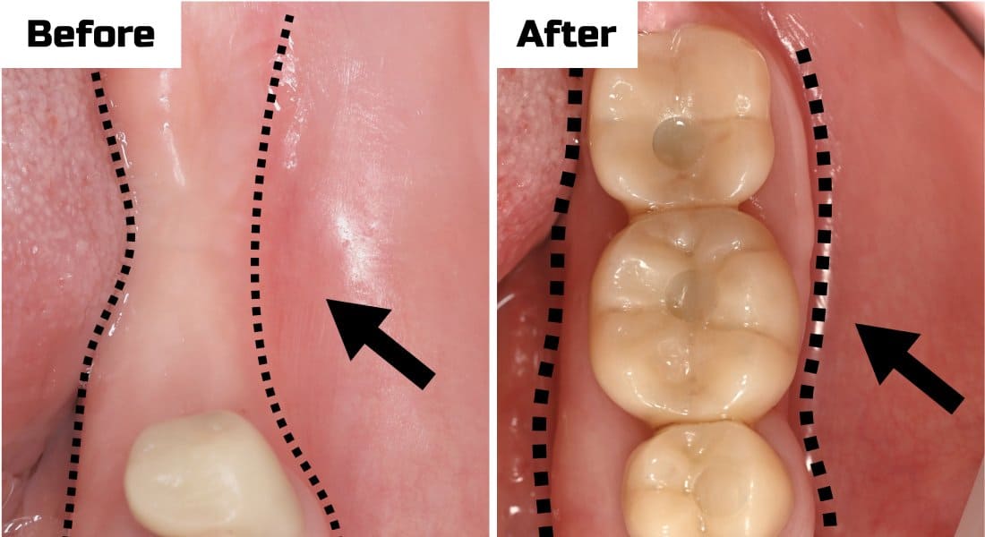 Tooth Extraction Treatment