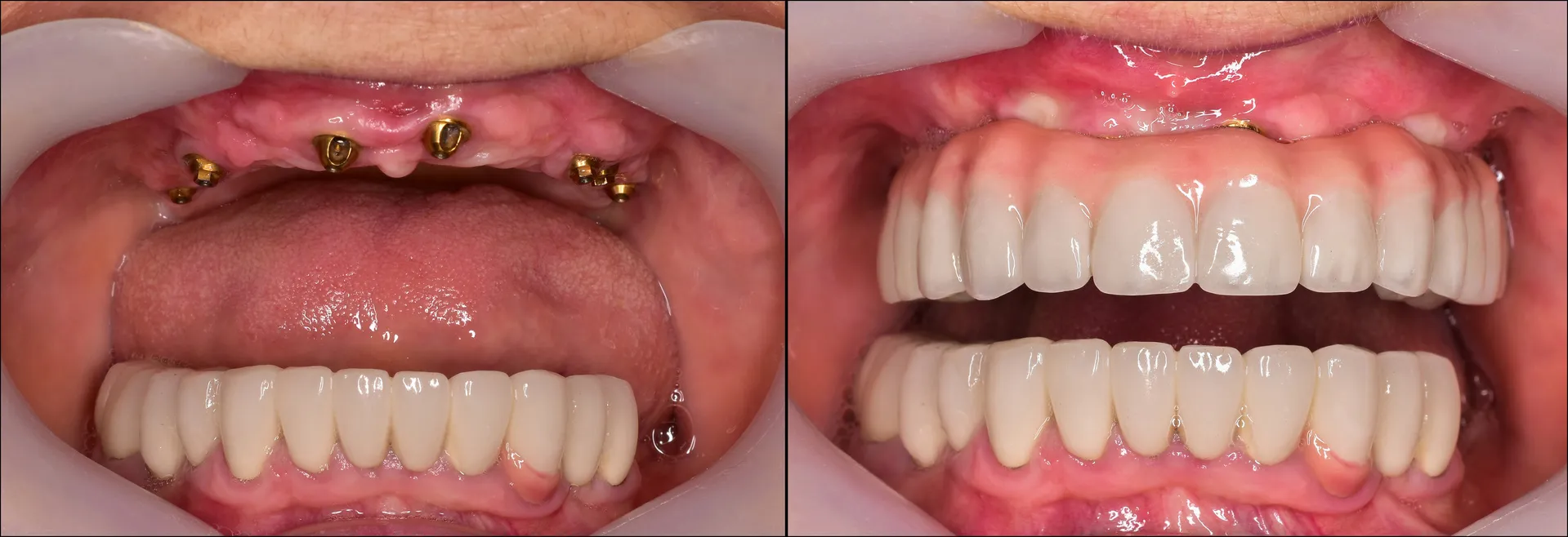 Implant Supported Denture