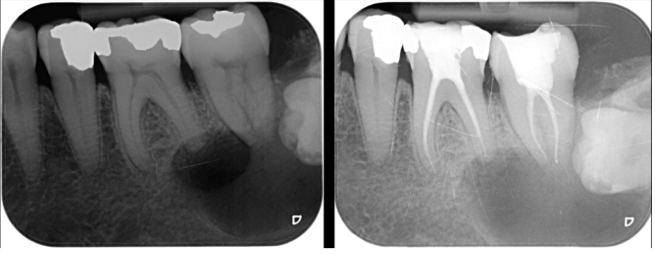 Periosurgery Treatment