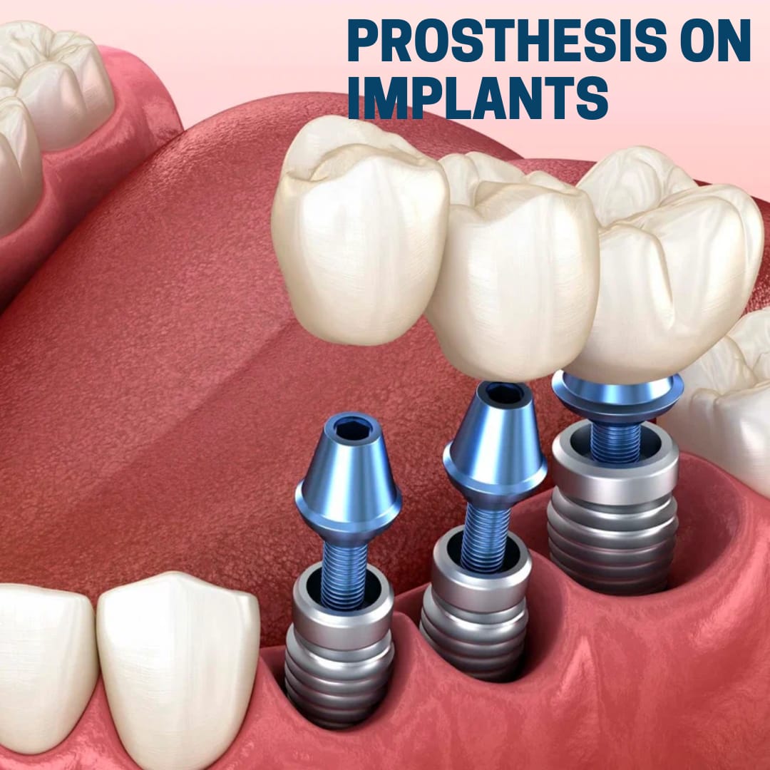 Dental Implant Treatment