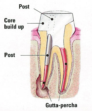 Post & Core Procedure