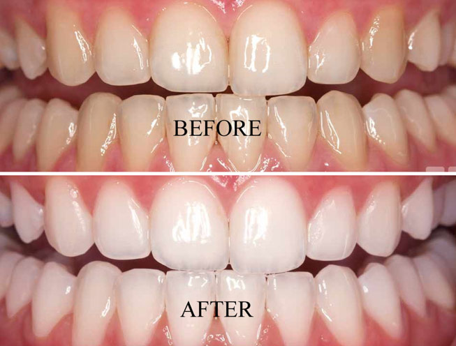 Teeth Whitening Procedure