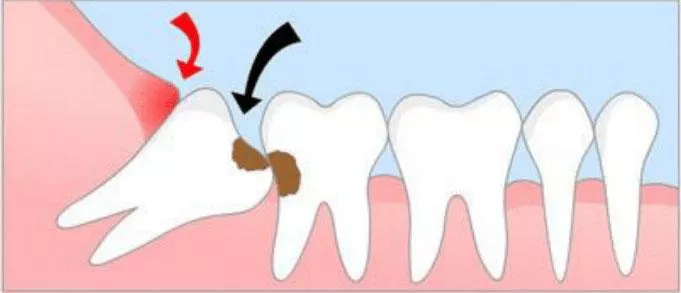 Wisdom Teeth Extraction Procedure